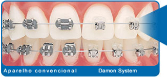 Aparelho convencional e Damon system